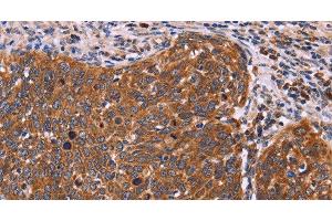 Immunohistochemistry of paraffin-embedded Human cervical cancer tissue using FBXW7 Polyclonal Antibody at dilution 1:40 (FBXW7 anticorps)