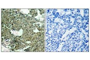 Immunohistochemical analysis of paraffin-embedded human breast carcinoma tissue using MEK1(Phospho-Ser221) Antibody(left) or the same antibody preincubated with blocking peptide(right).