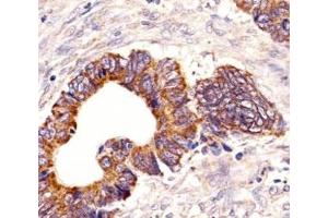 Immunohistochemical analysis of paraffin-embedded human colorectal carcinoma section using PCSK9 antibody