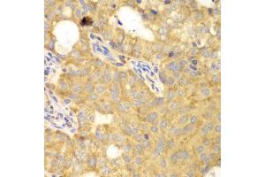 Immunohistochemistry of paraffin-embedded human oophoroma using GNB2L1 antibody at dilution of 1:100 (400x lens). (GNB2L1 anticorps)