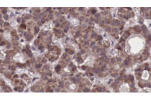 ABIN6273904 at 1/100 staining Human liver cancer tissue by IHC-P. (LPAR5 anticorps  (Internal Region))