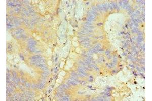 Immunohistochemistry of paraffin-embedded human colon cancer using ABIN7154050 at dilution of 1:100 (Glutaredoxin 2 anticorps  (AA 1-124))