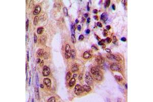 Immunohistochemical analysis of AMPK alpha 1/2 (pT183/172) staining in human lung cancer formalin fixed paraffin embedded tissue section. (PRKAA1/PRKAA2 anticorps  (pSer172, pSer183))