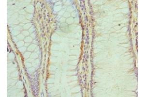 Immunohistochemistry of paraffin-embedded human colon cancer using ABIN7143717 at dilution of 1:100