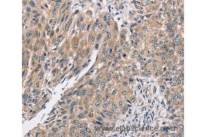 Immunohistochemistry of Human lung cancer using PPP1CC Polyclonal Antibody at dilution of 1:40