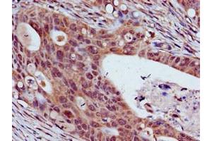 Immunohistochemistry of paraffin-embedded human colon cancer using ABIN7172051 at dilution of 1:100 (THO Complex 3 anticorps  (AA 2-351))