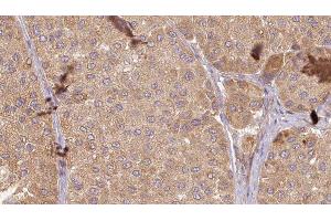 ABIN6277583 at 1/100 staining Human Melanoma tissue by IHC-P.