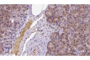 ABIN6273258 at 1/100 staining Human pancreas cancer tissue by IHC-P. (KCTD12 anticorps  (Internal Region))