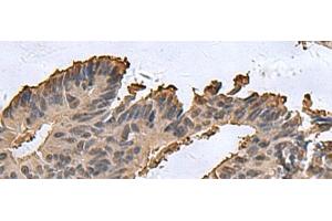 Immunohistochemistry of paraffin-embedded Human colorectal cancer tissue using DCTPP1 Polyclonal Antibody at dilution of 1:85(x200) (DCTPP1 anticorps)