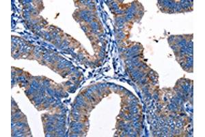 The image on the left is immunohistochemistry of paraffin-embedded Human cervical cancer tissue using ABIN7193124(Gjc3 Antibody) at dilution 1/10, on the right is treated with synthetic peptide. (GJC3 anticorps)
