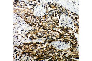Anti-Hamartin antibody, IHC(P) IHC(P): Human Mammary Cancer Tissue (TSC1 anticorps  (C-Term))