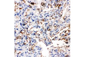 Anti-Aquaporin 1 antibody, IHC(P) IHC(P): Human Kidney Cancer Tissue (Aquaporin 1 anticorps  (C-Term))