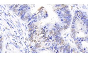 Detection of NPM1 in Human Colorectal cancer Tissue using Polyclonal Antibody to Nucleophosmin 1 (NPM1)