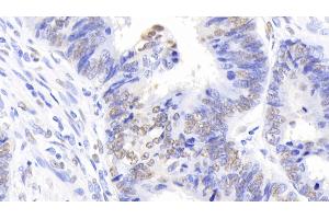 Detection of NPM1 in Human Colorectal cancer Tissue using Polyclonal Antibody to Nucleophosmin 1 (NPM1) (NPM1 anticorps  (AA 20-154))