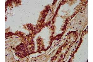 IHC image of ABIN7166221 diluted at 1:200 and staining in paraffin-embedded human prostate cancer performed on a Leica BondTM system. (IGSF9 anticorps  (AA 132-298))