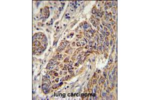 CYC1 Antibody immunohistochemistry analysis in formalin fixed and paraffin embedded human lung carcinoma followed by peroxidase conjugation of the secondary antibody and DAB staining. (Cytochrome C1 anticorps  (C-Term))