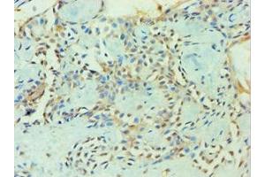 Immunohistochemistry of paraffin-embedded human breast cancer using ABIN7176252 at dilution of 1:100 (ZNF346 anticorps  (AA 1-294))