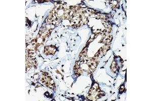 Immunohistochemistry of paraffin-embedded human breast cancer using SUFU Rabbit pAb (ABIN6133029, ABIN6148692, ABIN6148694 and ABIN6217424) at dilution of 1:100 (40x lens).