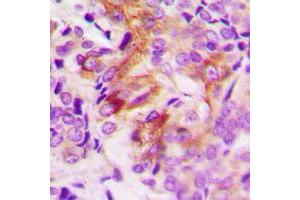 Immunohistochemical analysis of ANGPTL7 staining in human breast cancer formalin fixed paraffin embedded tissue section.