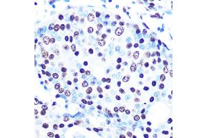 Immunohistochemistry of paraffin-embedded human breast cancer using SFPQ Rabbit mAb (ABIN7270547) at dilution of 1:100 (40x lens).