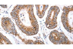 Immunohistochemistry of paraffin-embedded Human colon cancer tissue using HCRTR1 Polyclonal Antibody at dilution 1:70 (HCRTR1 anticorps)