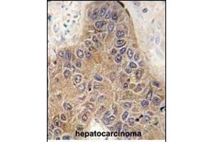 Formalin-fixed and paraffin-embedded human hepatocarcinoma tissue reacted with CHIP (STUB1) antibody (C-term) (ABIN390386 and ABIN2837936) , which was peroxidase-conjugated to the secondary antibody, followed by DAB staining.