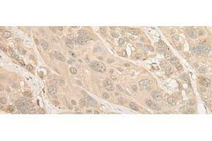 Immunohistochemistry of paraffin-embedded Human esophagus cancer tissue using PSMC4 Polyclonal Antibody at dilution of 1:25(x200)