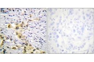 Immunohistochemistry analysis of paraffin-embedded human lung carcinoma tissue, using IGF2R (Ab-2484) Antibody. (IGF2R anticorps  (AA 2441-2490))