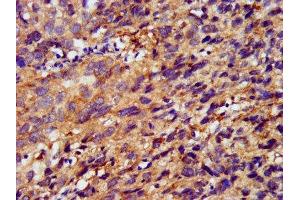 IHC image of ABIN7159577 diluted at 1:400 and staining in paraffin-embedded human ovarian cancer performed on a Leica BondTM system. (METAP1 anticorps  (AA 54-125))