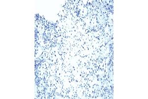 VHL Immunohistochemical staining on human renal cell carcinoma. (VHL anticorps  (AA 1-213))