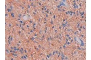 DAB staining on IHC-P; Samples: Human Glioma Tissue
