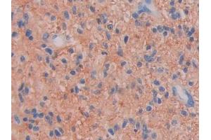 DAB staining on IHC-P; Samples: Human Glioma Tissue (Factor VII anticorps  (AA 334-452))