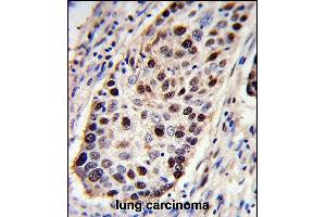 PCNA Antibody (C-term) (ABIN389344 and ABIN2839453) immunohistochemistry analysis in formalin fixed and paraffin embedded human lung carcinoma followed by peroxidase conjugation of the secondary antibody and DAB staining. (PCNA anticorps  (C-Term))
