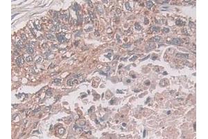 Detection of CXADR in Human Lung cancer Tissue using Polyclonal Antibody to Coxsackie Virus And Adenovirus Receptor (CXADR)