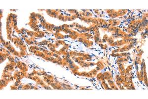 Immunohistochemistry of paraffin-embedded Human thyroid cancer tissue using AK5 Polyclonal Antibody at dilution 1:60 (Adenylate Kinase 5 anticorps)