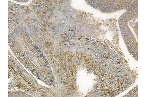 ABIN6260996 and ABIN6272569 at 1/100 staining human colon carcinoma by IHC-P.