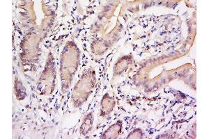 Formalin-fixed and paraffin embedded human colon carcinoma labeled with Anti-STAT3 (Tyr705) Polyclonal Antibody, Unconjugated  at 1:200 followed by conjugation to the secondary antibody and DAB staining.