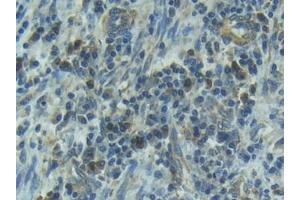 Detection of IL1R1 in Human Esophagus cancer Tissue using Polyclonal Antibody to Interleukin 1 Receptor Type I (IL1R1)