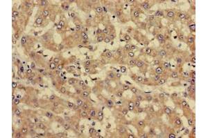 Immunohistochemistry of paraffin-embedded human liver cancer using ABIN7144337 at dilution of 1:100