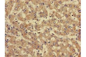 Immunohistochemistry of paraffin-embedded human liver cancer using ABIN7144337 at dilution of 1:100 (SERPINC1 anticorps  (AA 37-180))
