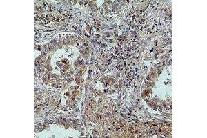 Immunohistochemical analysis of MICU1 staining in human lung cancer formalin fixed paraffin embedded tissue section.