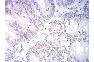 Immunohistochemical analysis of paraffin-embedded rectum cancer tissues using Neurod mouse mAb with DAB staining. (NEUROD1 anticorps  (AA 26-91))