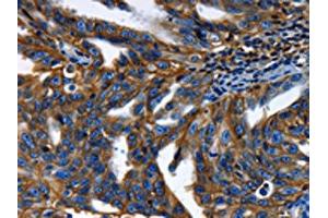 The image on the left is immunohistochemistry of paraffin-embedded Human ovarian cancer tissue using ABIN7189591(ABCC5 Antibody) at dilution 1/50, on the right is treated with synthetic peptide. (ABCC5 anticorps)