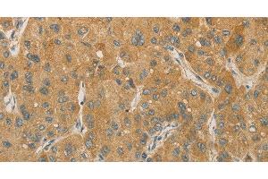 Immunohistochemistry of paraffin-embedded Human liver cancer tissue using PRPSAP1 Polyclonal Antibody at dilution 1:80 (PRPSAP1 anticorps)