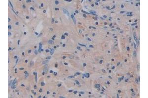 IHC-P analysis of Human Lung cancer Tissue, with DAB staining.
