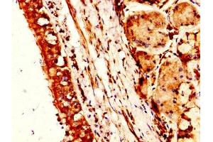IHC image of ABIN7161457 diluted at 1:300 and staining in paraffin-embedded human lung cancer performed on a Leica BondTM system. (Neurotensin anticorps  (AA 24-143))