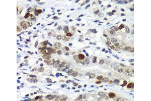 Immunohistochemistry of paraffin-embedded Human gastric cancer using DR1 Polyclonal Antibody at dilution of 1:100 (40x lens). (DR1 anticorps)