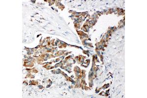 Anti-TRAM1 antibody, IHC(P) IHC(P): Human Lung Cancer Tissue