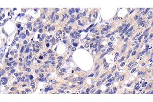 Detection of CASP8 in Human Lymphoma Tissue using Polyclonal Antibody to Caspase 8 (CASP8)