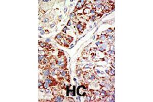 Formalin-fixed and paraffin-embedded human hepatocellular carcinoma tissue reacted with EZH1 polyclonal antibody  , which was peroxidase-conjugated to the secondary antibody, followed by DAB staining . (EZH1 anticorps  (Internal Region))